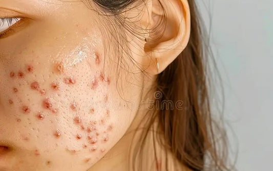 Understanding and Treating Acne: A Holistic Approach